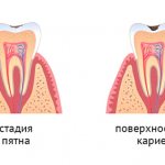 Начальная стадия кариеса. Характеризуется появлени