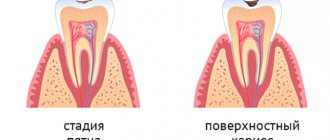 Initial stage of caries. Characterized by the appearance 