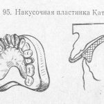 Накусочная пластинка Катца