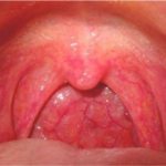 Normal condition of tonsils