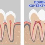 Aching toothache and gum inflammation. Tooth hurts - gums are swollen 