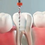 Root canal treatment