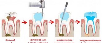 root canal treatment