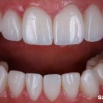 Обычно реставрация винирами проводится только в зоне улыбки – это 10 верхних и 8-10 нижних зубов