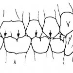 occlusion