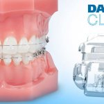 Features and benefits of the Damon Clear braces system