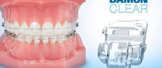 Features and benefits of the Damon Clear braces system