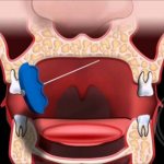 Osteitis