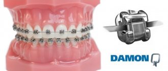 Reviews from specialists and patients about Damon Q braces