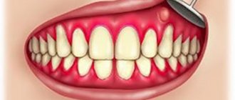 periodontal abscess article