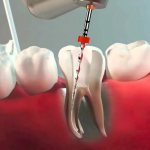 Root canal retreatment