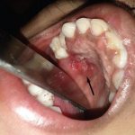 Perforation of the hard palate in tuberculosis