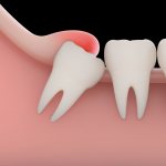 Wisdom tooth pericoronitis: symptoms, causes, treatment