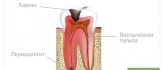 periodontitis of the tooth