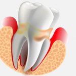 periodontitis