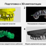 Подготовка к 3D-имплантации