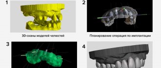 Подготовка к 3D-имплантации