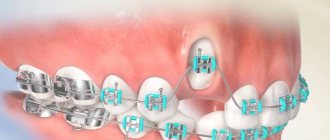 Indications and contraindications for orthodontic tooth traction