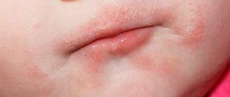 Покраснение вокруг рта у ребенка. Фото, причины и лечение, рацион питания