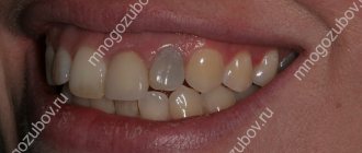 After treatment the tooth darkened