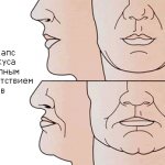 Consequences for the face in the absence of teeth