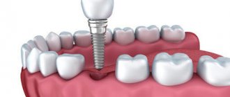 Причины болезненных ощущений после имплантации зубов