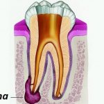причины появления кисты зуба