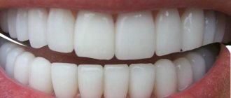 Causes of crooked jaw development and its correction