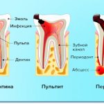 Signs of caries, pulpitis and periodontitis