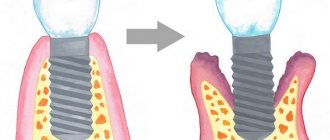 Signs of Dental Implant Rejection