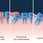 Wisdom tooth eruption