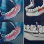 Carrying out bone grafting