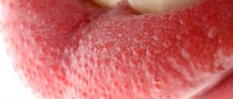 Pimples on a child&#39;s tongue