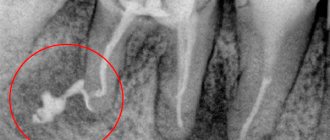 Pulpitis toothache