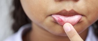 blisters on a child&#39;s mouth