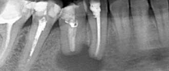 radicular cyst