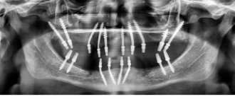 X-ray of basal implantation