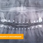 X-ray with undetected figure eights