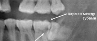 dental x-ray