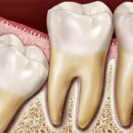 squeezing the adjacent tooth with a figure eight