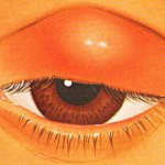 Lump on the upper eyelid