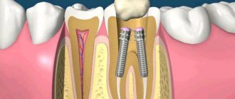 Pin in tooth