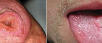 syphilis of the tongue in the primary period