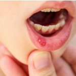 Symptoms and treatment of stomatitis in children