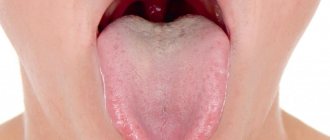 Symptoms and home treatment of uvulitis, causes of swelling and swelling of the uvula in the throat