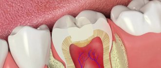 How long will the filling last? - How long does a temporary filling last? 