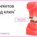 How much does it cost to install braces in Ulan Ude?