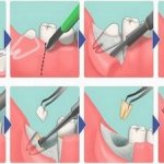 Complex wisdom tooth removal