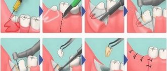 Complex wisdom tooth removal