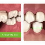 смещение зубов после удаления